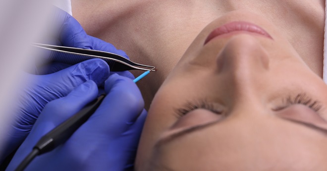 Poliklinika DIVA: Uklanjanje mladeža radiotalasnom tehnikom (foto: Andreja Damnjanović)